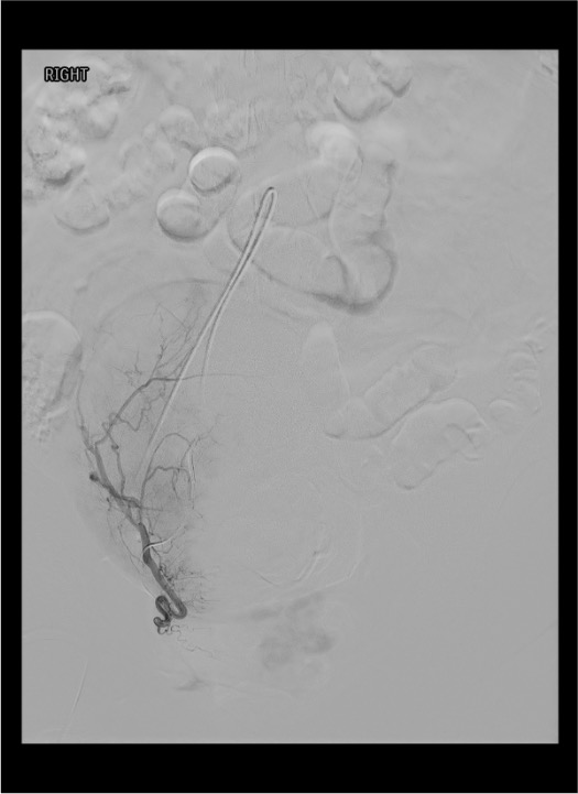 Superselective right uterine artery catheterization demonstrating fibroid vascular supply