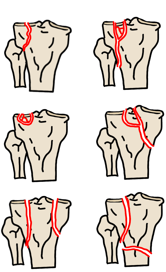 Schatzker classification: I lateral split; II lateral split-depression; III focal lateral depression; IV medial plateau; V bicondylar; VI bicondylar with metaphyseal dissociation