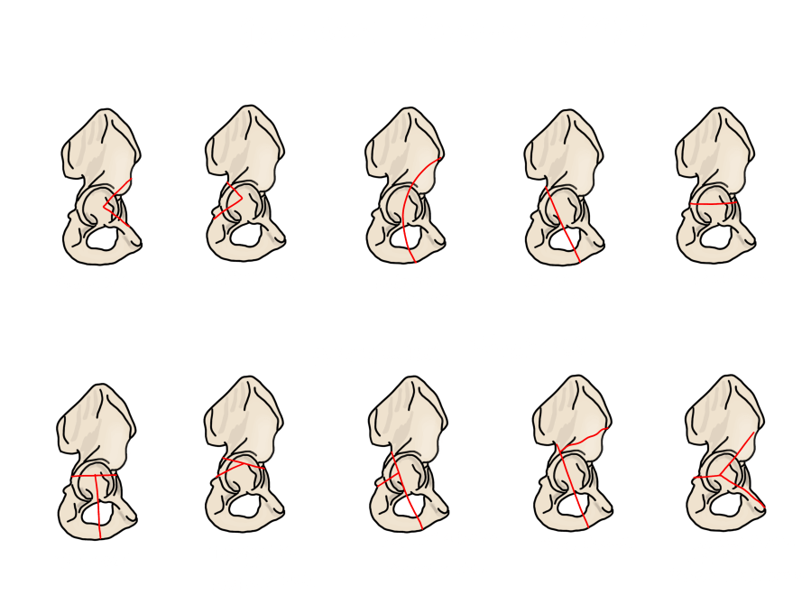 Judet-Letournel classification of acetabular fractures — 5 elementary types (posterior wall, posterior column, anterior wall, anterior column, transverse) and 5 associated types