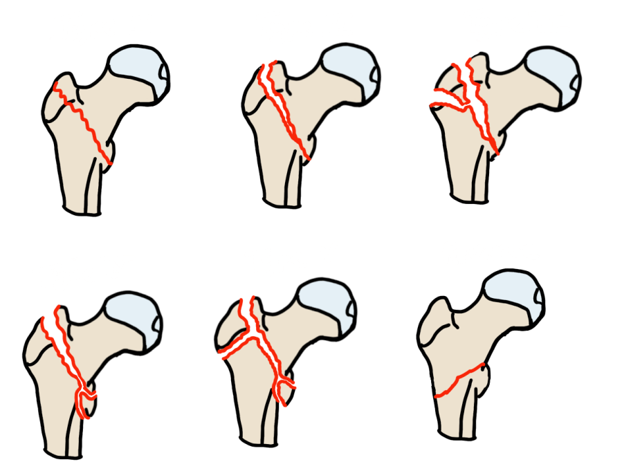 Evans classification of intertrochanteric fractures — stable vs unstable based on posteromedial cortex integrity