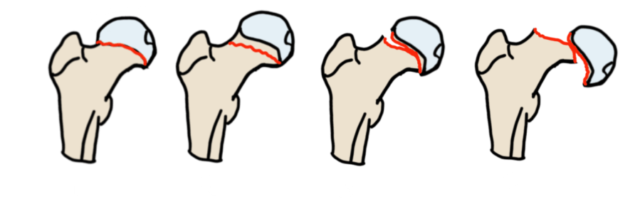 Garden classification: I incomplete valgus impacted; II complete nondisplaced; III partial displacement; IV fully displaced