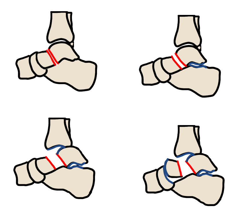 Hawkins-Canale classification: I nondisplaced (~10% AVN); II + subtalar dislocation (~30%); III + tibiotalar dislocation (>90%); IV + talonavicular dislocation (>90%)