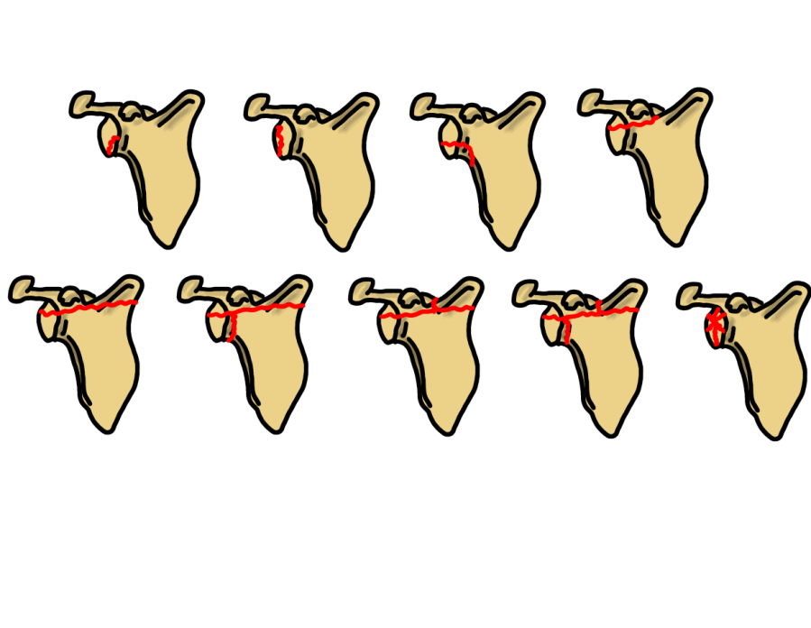 Ideberg glenoid fracture classification — nine scapula views showing fracture line patterns for types 1a through 6