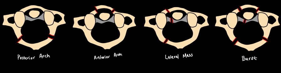 C1 atlas fracture patterns — posterior arch, anterior arch, lateral mass, and burst fracture types in axial view
