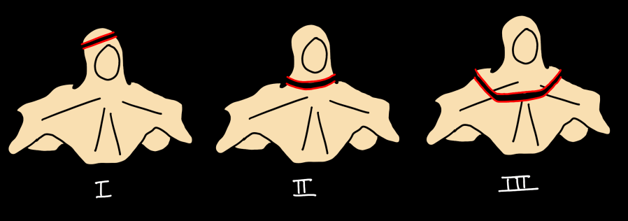Odontoid fracture classification — Anderson-D'Alonzo Type I tip avulsion, Type II base of odontoid, Type III extending into C2 body