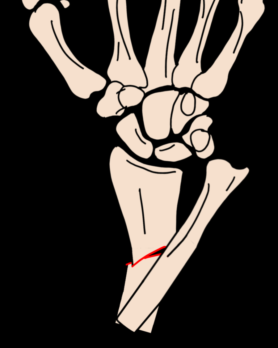 Galeazzi fracture-dislocation — distal radial shaft fracture with DRUJ dislocation