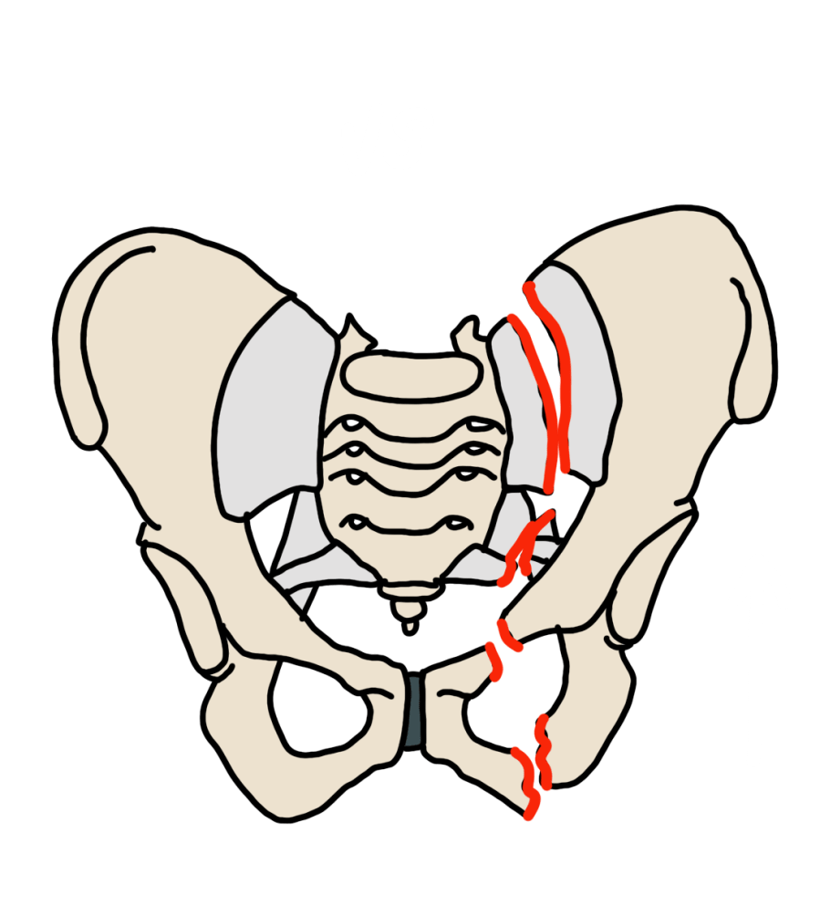 Vertical shear pelvic fracture — complete hemipelvis displacement superiorly with anterior and posterior ring disruption